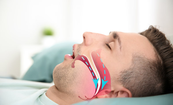 Viêm amidan mạn có thể dẫn đến biến chứng ngưng thở khi ngủ do tắc nghẽn
